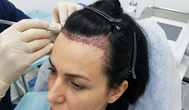 کاشت مو زنان و هر آنچه باید درباره آن بدانید